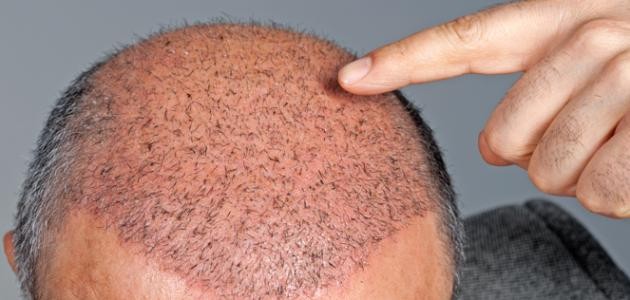 ما هي زراعة الشعر