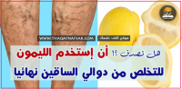 علاج دوالي الساق بالليمون