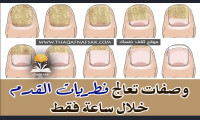 علاج فطريات القدم خلال ساعة فقط علاج فطريات القدم خلال ساعة فقط