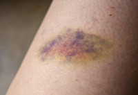 كدمات الجسم علاجها وأسباب ظهورها بالفيديو لن تشتكي منها بعد اليوم