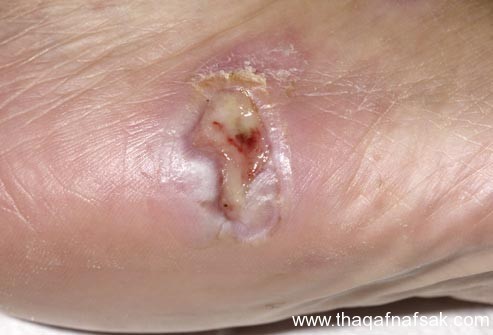 بالصور : اعرف صحتك من قدمك