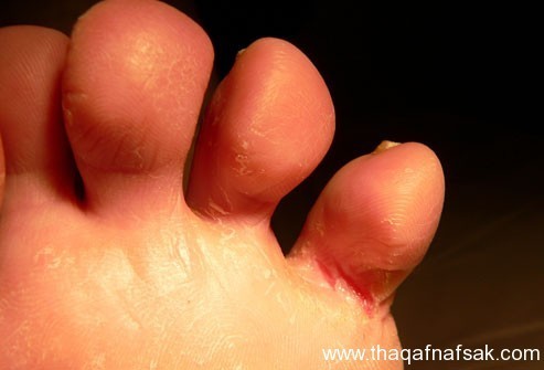 بالصور : اعرف صحتك من قدمك