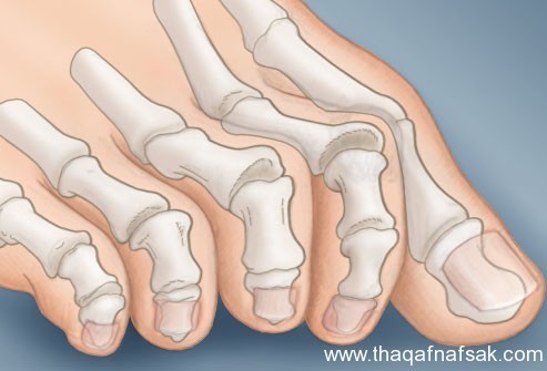 بالصور : اعرف صحتك من قدمك