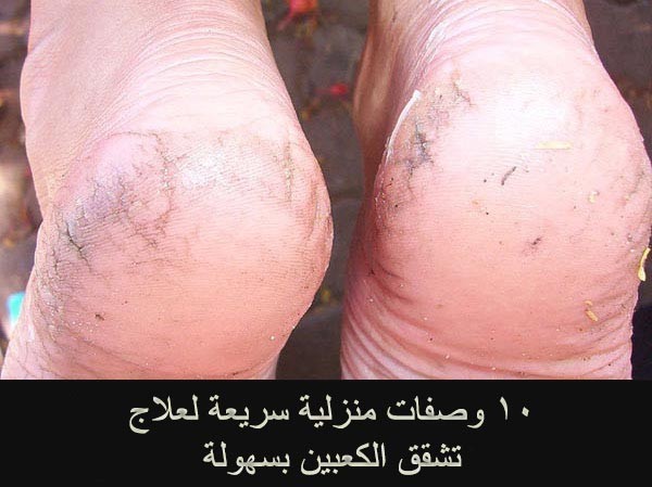وصفات لعلاج تشقق الكعبين١٠ وصفات منزلية اصنعها بنفسك لعلاج تشققات عقب القدم وصفات لعلاج تشقق الكعبين١٠ وصفات منزلية اصنعها بنفسك لعلاج تشققات عقب القدم