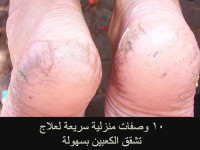 وصفات لعلاج تشقق الكعبين١٠ وصفات منزلية اصنعها بنفسك لعلاج تشققات عقب القدم