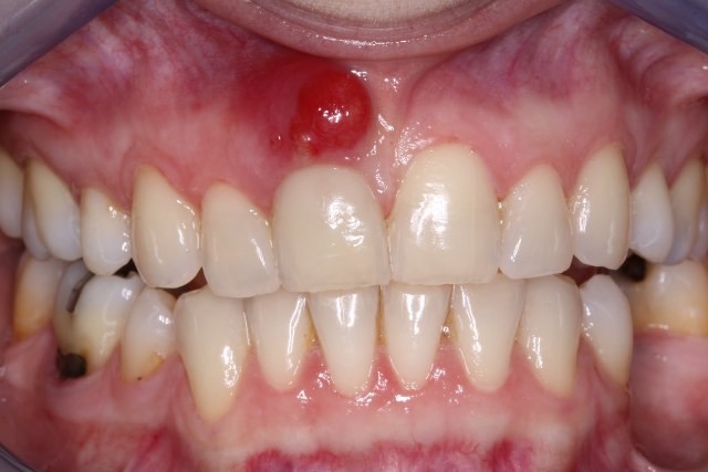 طرق علاج خراج الأسنان منزلياً بدون أدوية بعشرة وصفات سريعه طرق علاج خراج الأسنان منزلياً بدون أدوية بعشرة وصفات سريعه