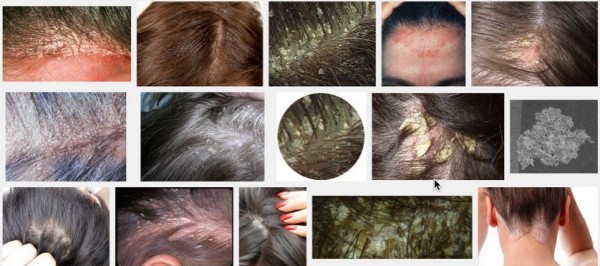 مرجع كامل حول قشرة الشعر اسبابها وعلاجها مرجع كامل حول قشرة الشعر اسبابها وعلاجها