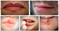 علاج قرح البرد في المنزل و تخلص من شكلها المزعج بسرعة
