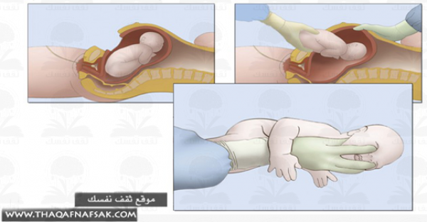 مخاطر وأضرار الولادة القيصرية التي يجب أن تعرفينها