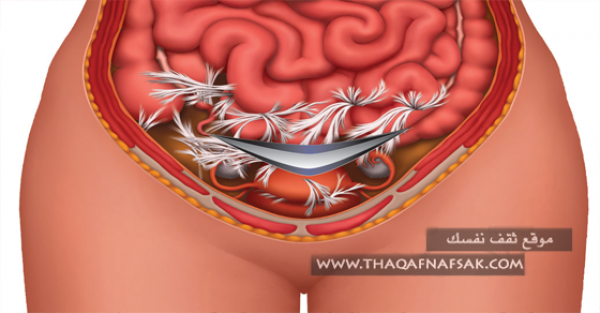 كيف تخفين أثار الولادة القيصرية علي البطن كيف تخفين أثار الولادة القيصرية علي البطن