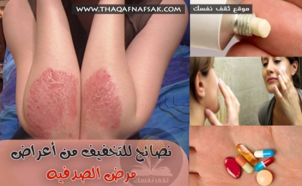 7 نصائح للتخفيف أعراض مرض الصدفية