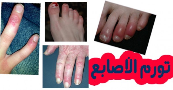 ١٠ طرق منزلية فعاله في علاج تورم الاصابع في الشتاء ١٠ طرق منزلية فعاله في علاج تورم الاصابع في الشتاء