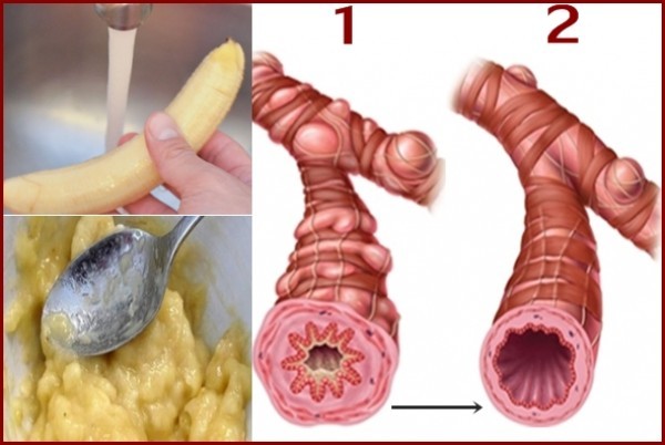 ١٨وصفة لعلاج التهاب الشعب الهوائية ١٨وصفة لعلاج التهاب الشعب الهوائية