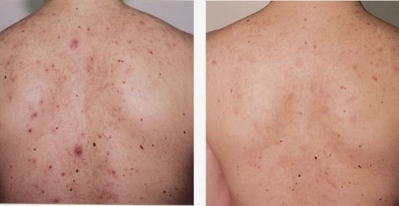 علاج حبوب الظهر بوصفات طبيعية علاج حبوب الظهر بوصفات طبيعية