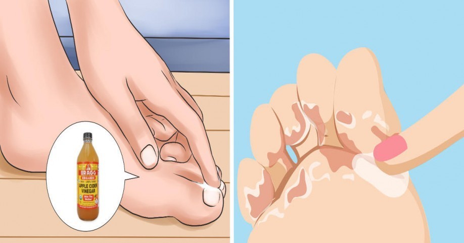 علاج فطر القدم باستخدام خل التفاح