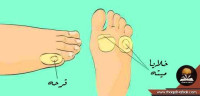 بالصور علاج قرحة القدم طبيعيا