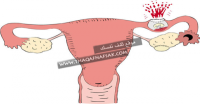 كيف يحدث الحمل خارج الرحم والأعراض والمخاطر