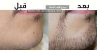 طرق زيادة شعر اللحية الخفيف عند الرجال