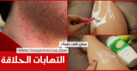 التهاب الجلد بعد الحلاقة والعلاجات الفعالة له التهاب الجلد بعد الحلاقة والعلاجات الفعالة له