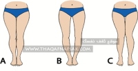 مشكلة تقوس الساقين الأسباب والعلاج