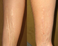 علاج ندبات الجلد بوصفات طبيعية من البيت علاج ندبات الجلد بوصفات طبيعية من البيت