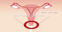 علاج حبوب المهبل طبيعياً ١١ وصفة أجنبية علاج حبوب المهبل طبيعياً ١١ وصفة أجنبية