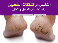 التخلص من تشققات الكعبين باستخدام العسل والخل التخلص من تشققات الكعبين باستخدام العسل والخل