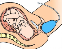 قطع العجان وطريق علاج غرز الولادة الطبيعية