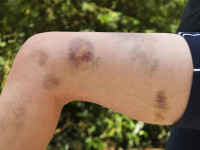 جلطات الدم أسبابها ومخاطرها وطرق علاجها