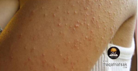 علاج الحبوب تحت الجلد بـ ١٤ طريقة سريعة علاج الحبوب تحت الجلد بـ ١٤ طريقة سريعة