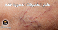علاج الشعيرات الدموية المنفجرة بـ ١٥ طريقة ومنعها تماماً من الظهور