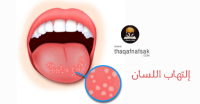 علاج إلتهاب اللسان دوائياً وطبيعياً