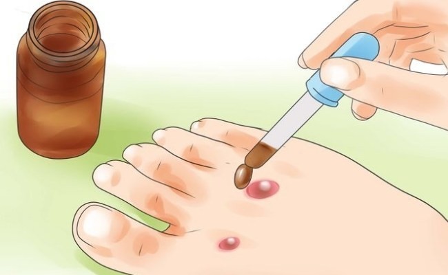 علاج البثور الدموية بطرق طبيعية