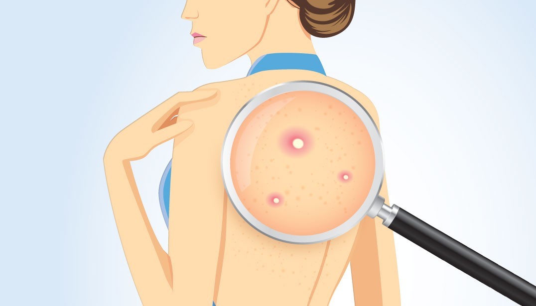 علاج حب الشباب في الظهر بـ 7 خطوات سهلة