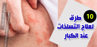علاج التسلخات عند الكبار بـ ١٠ طرق علاج التسلخات عند الكبار بـ ١٠ طرق