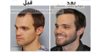 تكثيف شعر الذقن للشباب بوصفات طبيعية