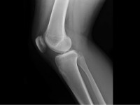 إلتهاب الغضاريف الأسباب والعلاج