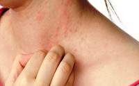 حمو النيل أسبابه واعراض وطرق علاجه والوقاية منه حمو النيل أسبابه واعراض وطرق علاجه والوقاية منه