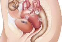 بطانة الرحم المهاجرة اسبابها وطرق علاجها والتعامل في هذه الحاله