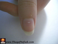 ما هي البقع البيضاء على الأظافر ؟ ما هي البقع البيضاء على الأظافر ؟