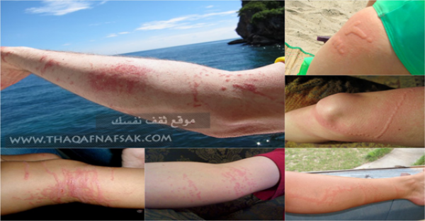 لسعة قنديل البحر كيف تتجنبها والإسعافات الأولية لها