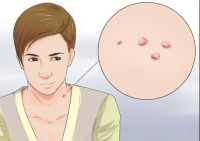 أسباب الزوائد الجلدية وعلاجها في أي منطقة بالجسم أسباب الزوائد الجلدية وعلاجها في أي منطقة بالجسم