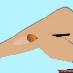 علاج علامات التمدد والخطوط البيضاء على الفخذين والساقين بالصور علاج علامات التمدد والخطوط البيضاء على الفخذين والساقين بالصور