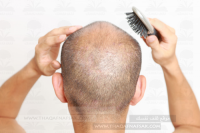 أهم 10 خطوات لزيادة كثافة الشعر للرجال