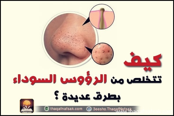 بالصور كيفية ازالة الرؤوس السوداء نهائيا ١٣ طريقة منزلية فعالة بالصور كيفية ازالة الرؤوس السوداء نهائيا ١٣ طريقة منزلية فعالة