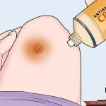 بالصور خطوات علاج الخراج في البيت بطرق طبيعية في زمن قياسي