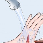 بالصور خطوات علاج الخراج في البيت بطرق طبيعية في زمن قياسي