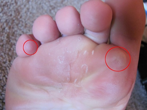 10 طرق طبيعية فعالة في علاج بثور القدم