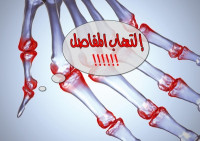 بالصور أهم الطرق التي تساعدك في علاج إلتهاب المفاصل بالصور أهم الطرق التي تساعدك في علاج إلتهاب المفاصل