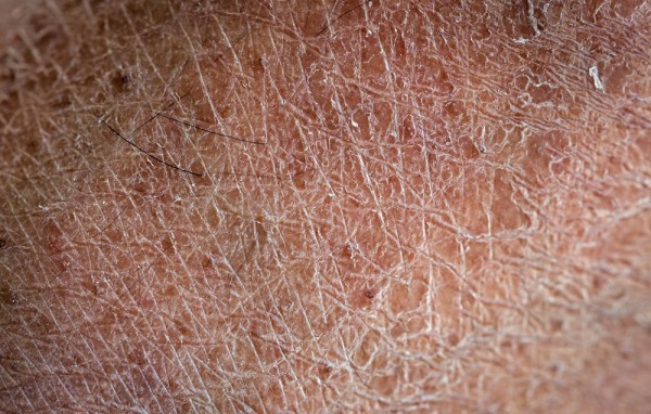 فيديو يوضح أسباب جفاف البشرة